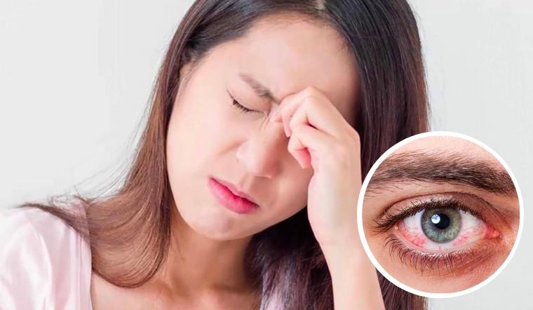 Bị đau mắt đỏ nên làm gì? 3 cách chữa đau mắt đỏ tại nhà