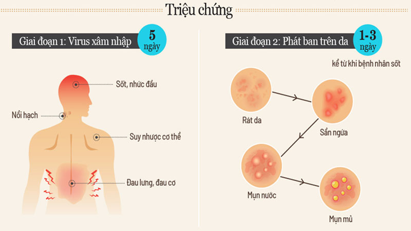 Triệu chứng của bệnh đậu mùa khỉ