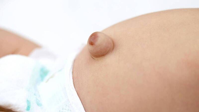 What is an umbilical hernia in a child? When should surgery be performed?