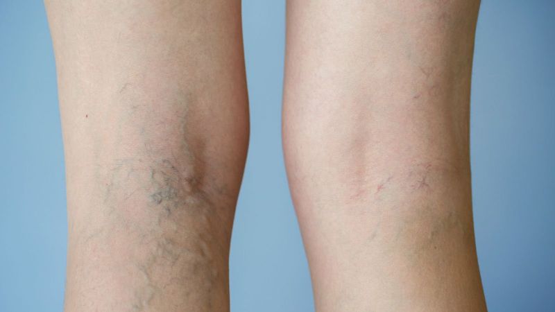 What is varicose veins? Causes, symptoms and prevention