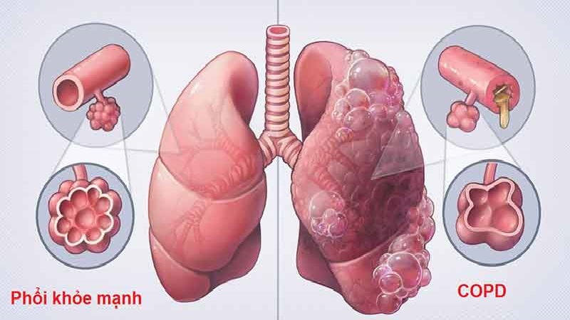 Bệnh COPD liên quan đến viêm phế quản mạn tính