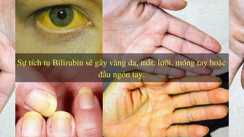 Vàng da, vàng mắt là một dấu hiệu của bệnh gan
