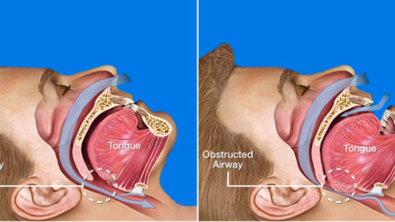 Hội chứng ngừng thở khi ngủ là gì?