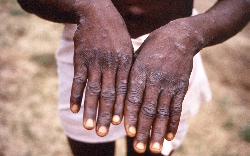 Bệnh đậu mùa khỉ đã xuất hiện rất lâu trước đây vào năm 1970 tại Congo. 