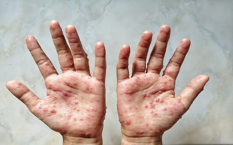 Bệnh đậu mùa không thể xét nó là một căn bệnh lây truyền qua đường tình dục