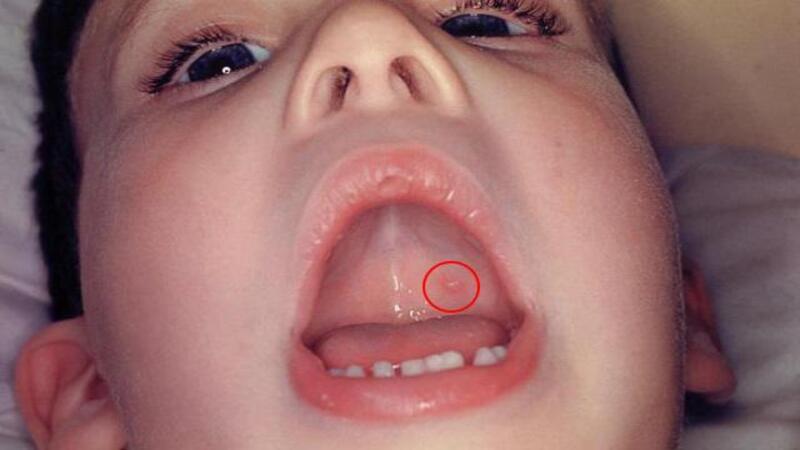 Loét miệng có thể xuất hiện khi nhiễm thủy đậu gây khó chịu cho người bệnh Loét miệng có thể xuất hiện khi nhiễm thủy đậu gây khó chịu cho người bệnh