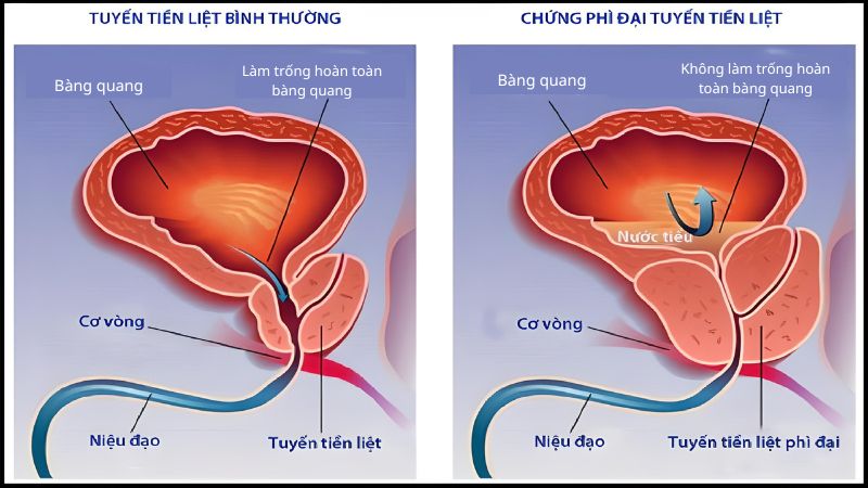 Sưng tiền liệt tuyến