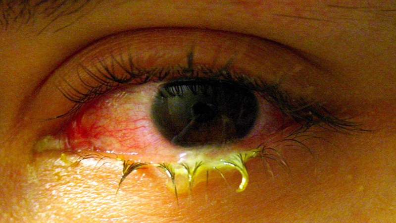 3 nguyên nhân đau mắt đỏ thường gặp và cách phòng ngừa