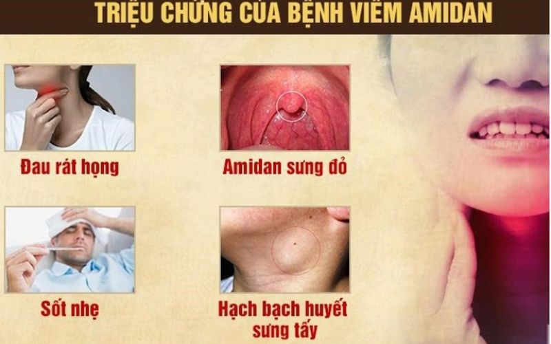 Triệu chứng của viêm amidan