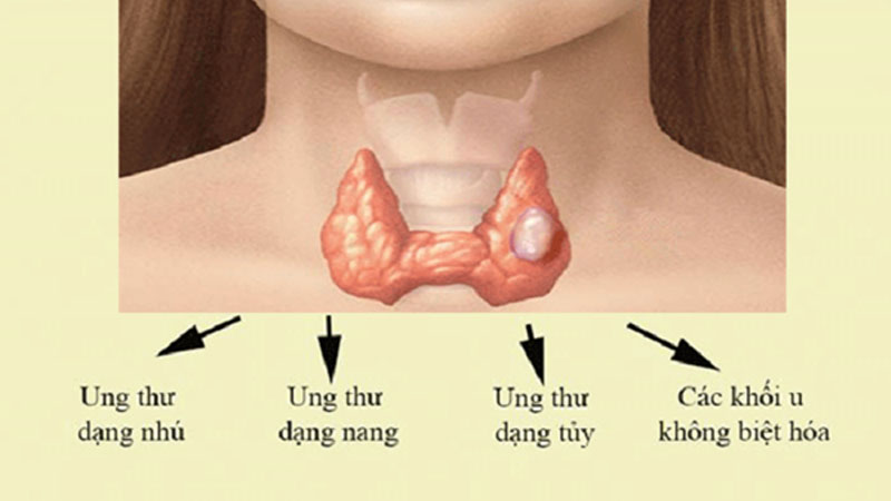 Các thể trong ung thư tuyến giáp