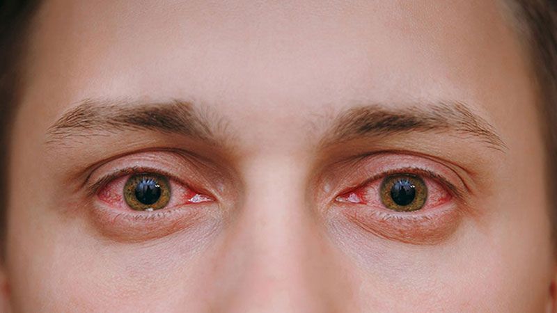 Đau mắt đỏ lây qua đường nào? Cách phòng ngừa bệnh đau mắt đỏ
