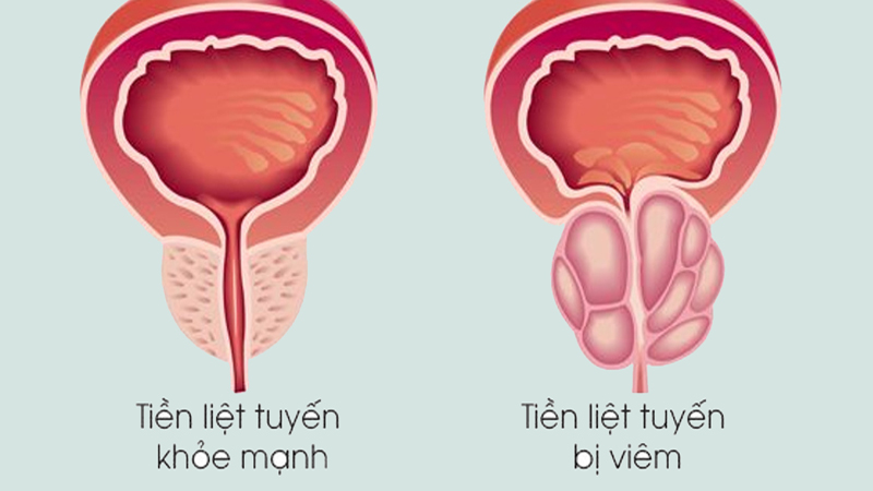 Tiền liệt tuyến bị viêm.