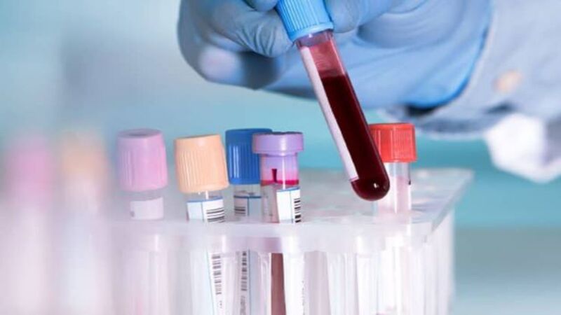 Xét nghiệm máu là một trong các phương pháp chẩn đoán sỏi thận