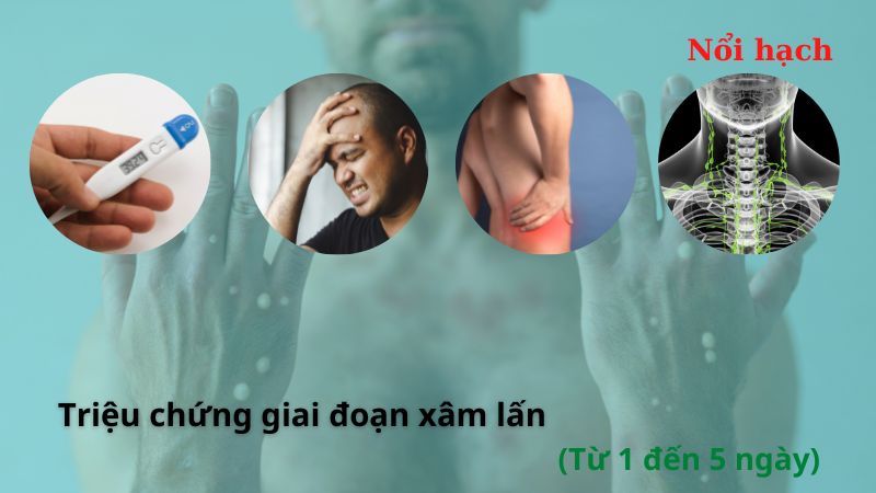 Dấu hiệu đậu mùa khỉ giúp bạn nhận biết bệnh chính xác