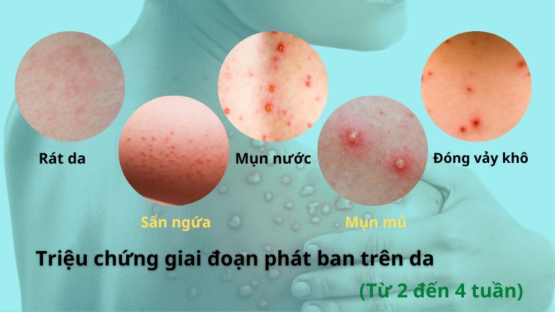 Giai đoạn phát ban của đậu mùa khỉ thường kéo dài 2-4 tuần, từ các vết ngứa rát trên da phát triển thành các mảng vảy khô