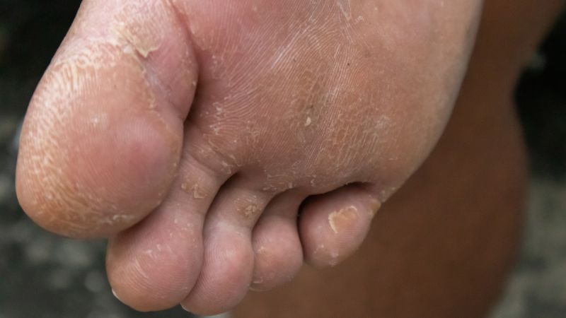 Treating foot blisters