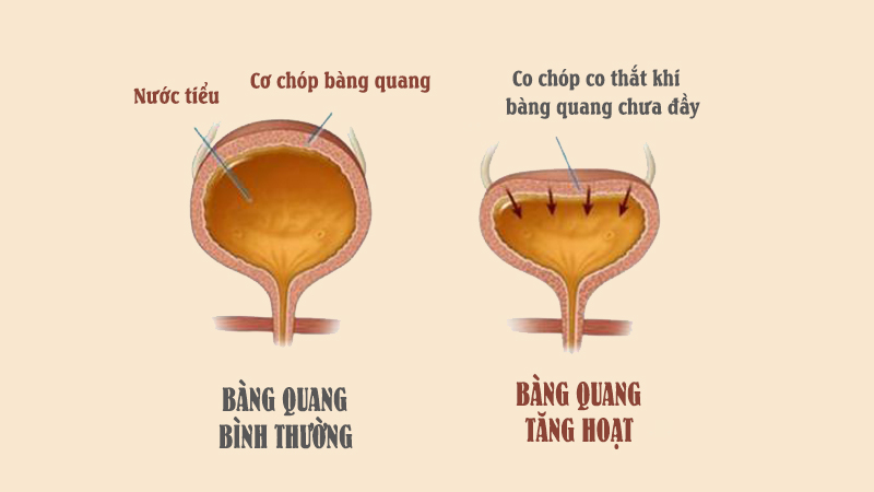 Bàng quang tăng hoạt nên ăn gì? 7 loại thực phẩm tốt cho bàng quang