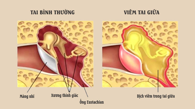 Viêm tai giữa là tình trạng virus hoặc vi khuẩn xâm nhập vào phần dịch nhầy tích tụ trong tai giữa gây viêm