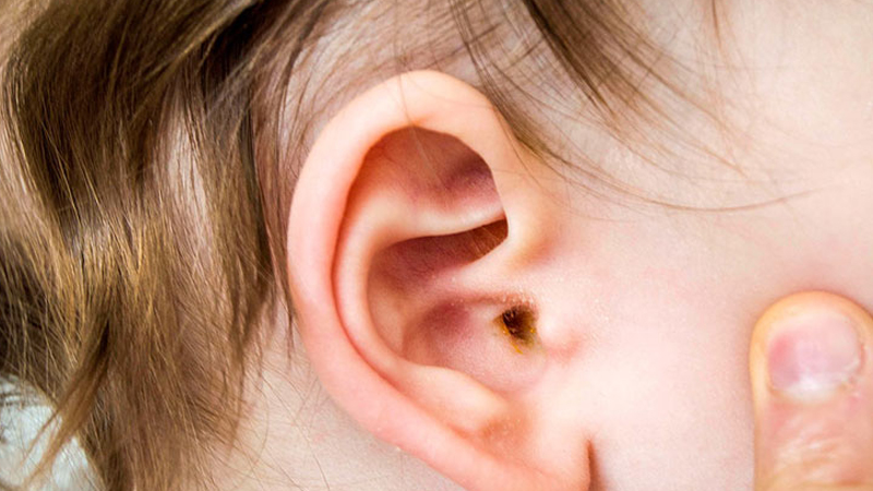 Viêm tai giữa có thể tự khỏi trong 2 đến 3 ngày đối với trường hợp nhẹ