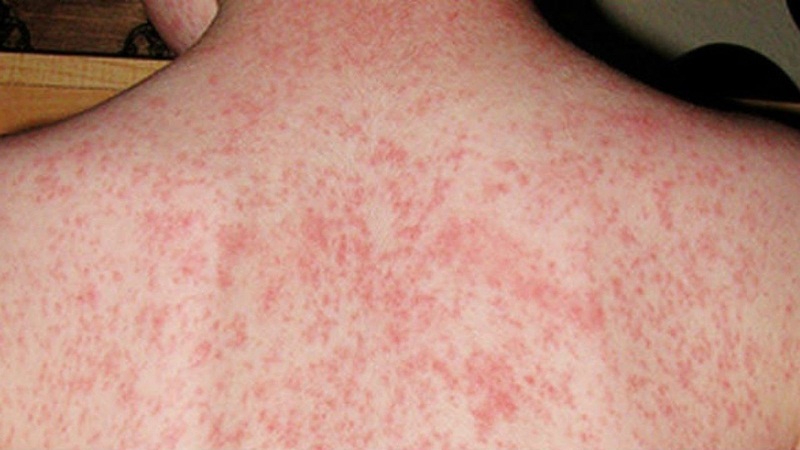 Sốt ban đỏ là biến chứng liên quan đến hệ thống miễn dịch
