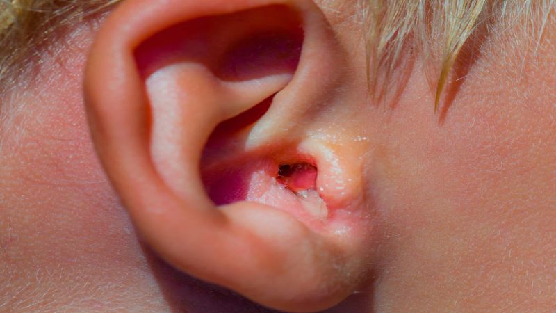 Viêm tai ngoài có tự khỏi không và bao lâu thì khỏi?