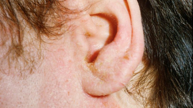 Ngứa và đỏ nhẹ trong tai là biểu hiện của nhiễm trùng tai mức độ nhẹ