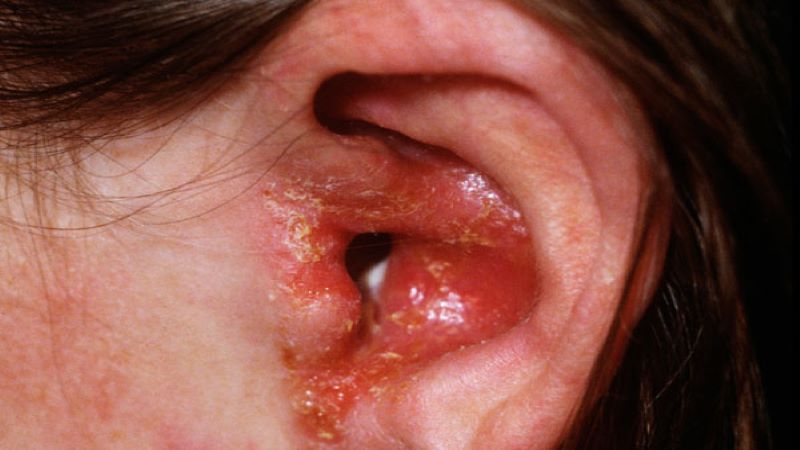 Tai đỏ nhiều hơn là dấu hiệu của nhiễm trùng tai mức độ trung bình