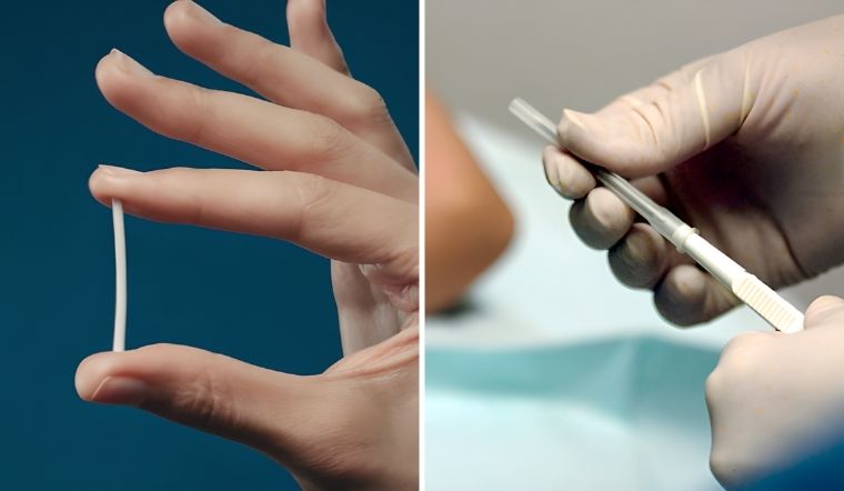 Sau khi rút que cấy tránh thai Implanon thì bao lâu có thể mang thai trở lại?
