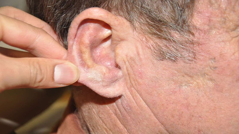 Ung thư tai cũng sẽ gây chảy máu tai