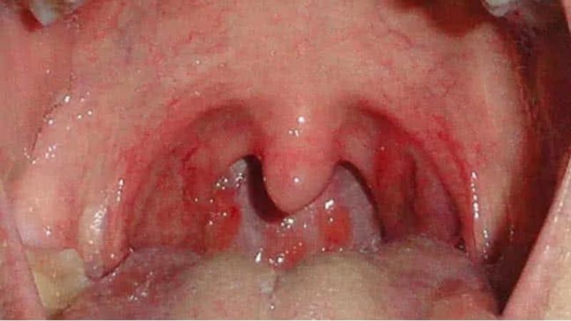 Đau họng kèm theo sung huyết, sưng đỏ và sưng amidan trên bệnh nhân viêm họng hạt