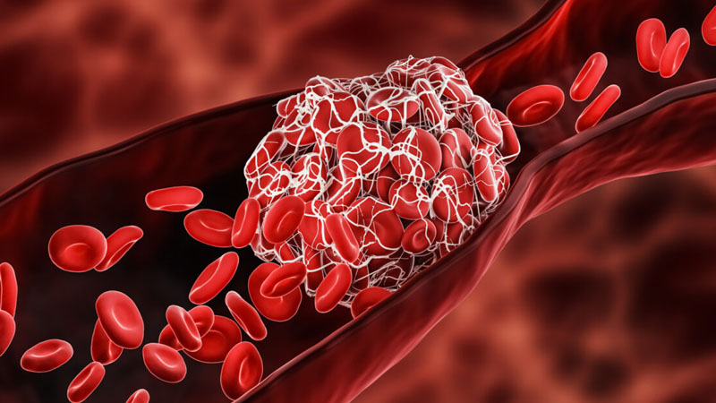 Bệnh bạch cầu có thể gây ra thuyên tắc mạch máu do cục máu đông