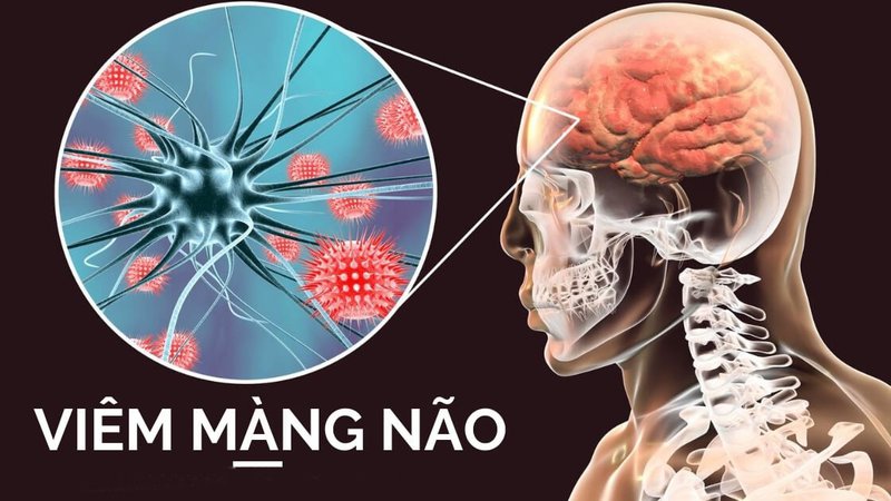 3 triệu chứng viêm màng não thường gặp bạn cần chú ý