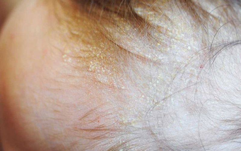 Nguyên nhân dẫn đến viêm da tiết bã vẫn chưa được xác định