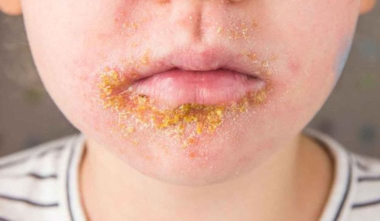 Những việc cha mẹ cần làm khi con bị bệnh chốc