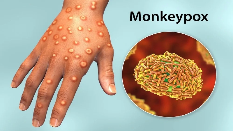 Phát ban là triệu chứng điển hình của đậu mùa khỉ