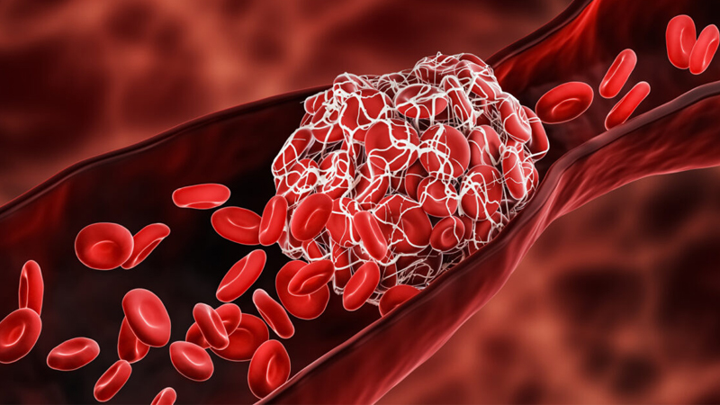 Các cục máu đông hình thành gây tắc mạch