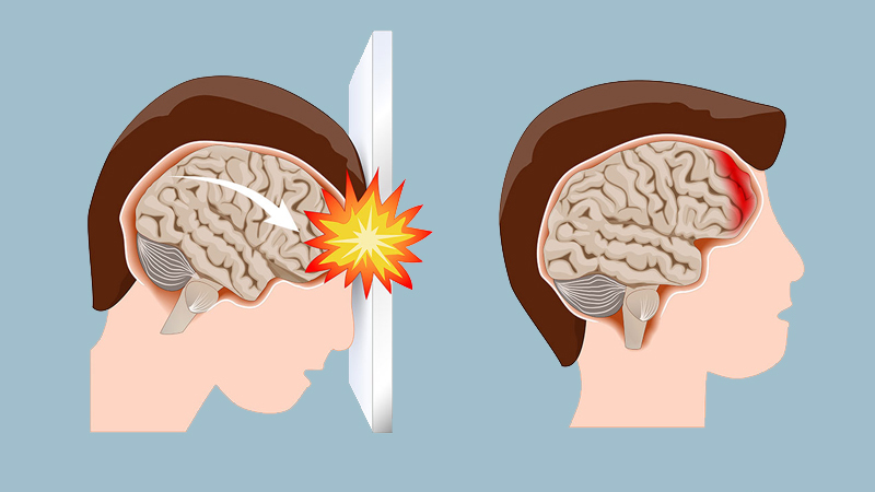 Hiện Tượng Xuất Huyết Não: Nguyên Nhân, Triệu Chứng Và Cách Phòng Ngừa Hiệu Quả