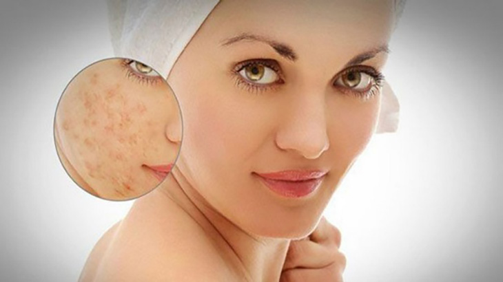 Sulfur ointment has the ability to diminish acne scars