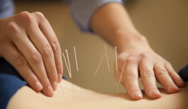 Phương pháp châm cứu là gì, có lợi ích gì đối với sức khỏe?