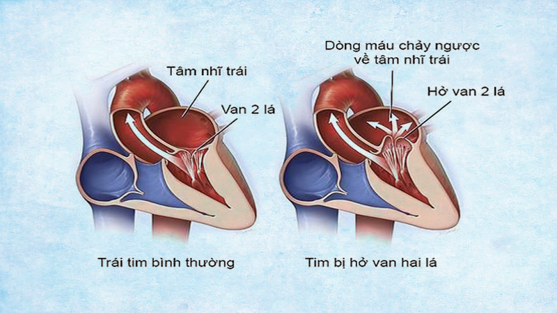 Van tim bất thường dẫn tới bệnh suy tim