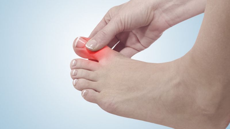 Cảnh báo triệu chứng bệnh gút (gout) có thể bạn đang gặp phải