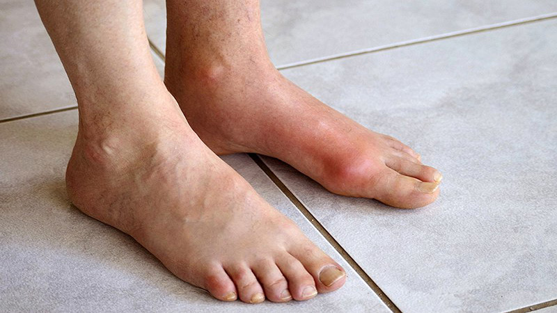 Bệnh gout gây viêm khớp với các triệu chứng như sưng, nóng, đỏ, đau