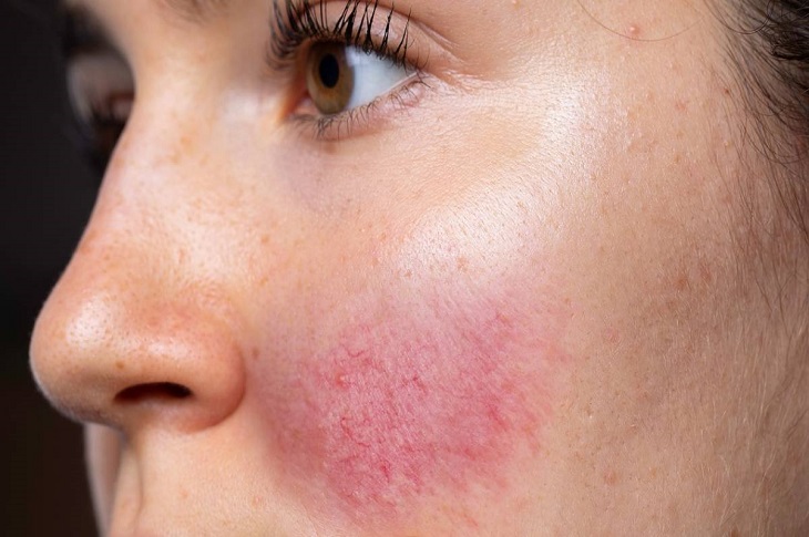 Skin infection caused by using brushes and sponges containing bacteria