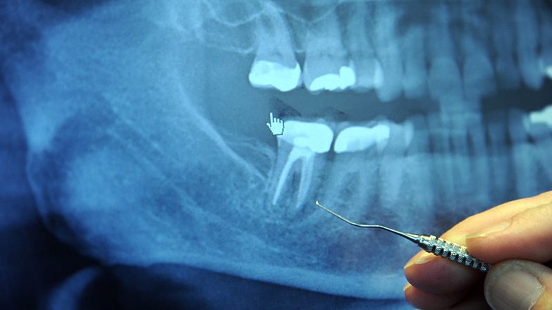 Sử dụng phương pháp chụp X - quang để chẩn đoán áp xe răng