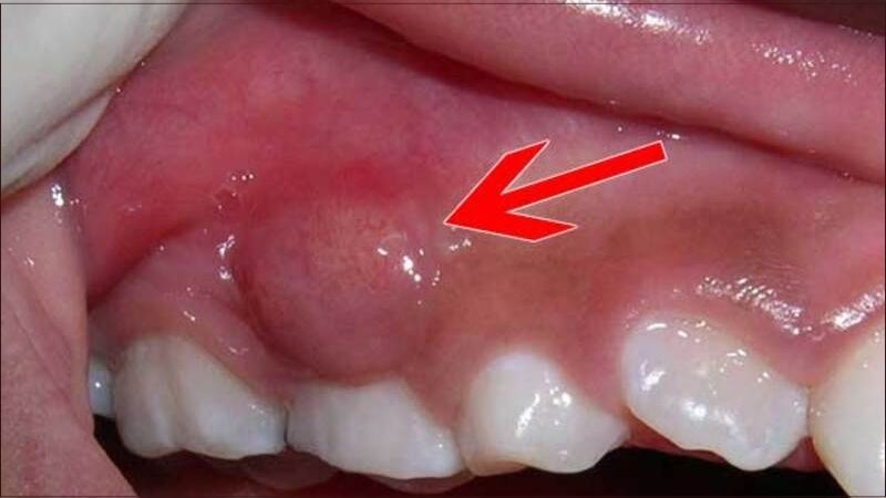 Áp xe răng có nguy hiểm không? Các biến chứng của áp xe răng