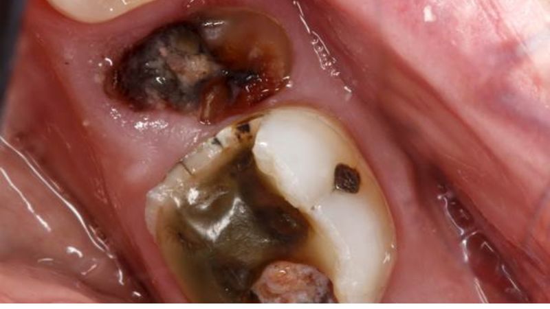 Biểu hiện của áp xe răng khi không được điều trị