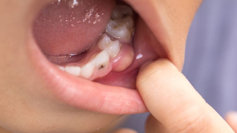 Triệu chứng áp xe răng