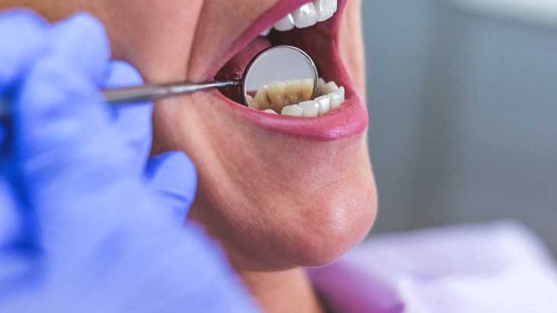 Khám răng ngay khi có triệu chứng áp xe răng