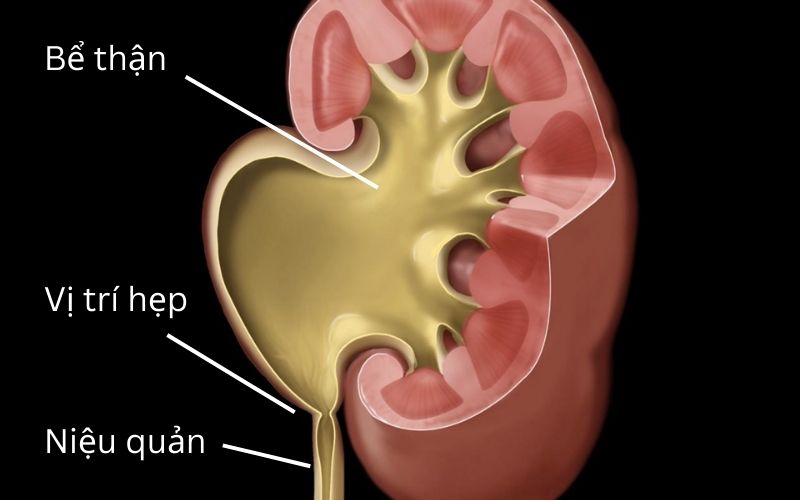 Nguyên nhân nào dẫn đến hẹp khúc nối bể thận niệu quản ở trẻ