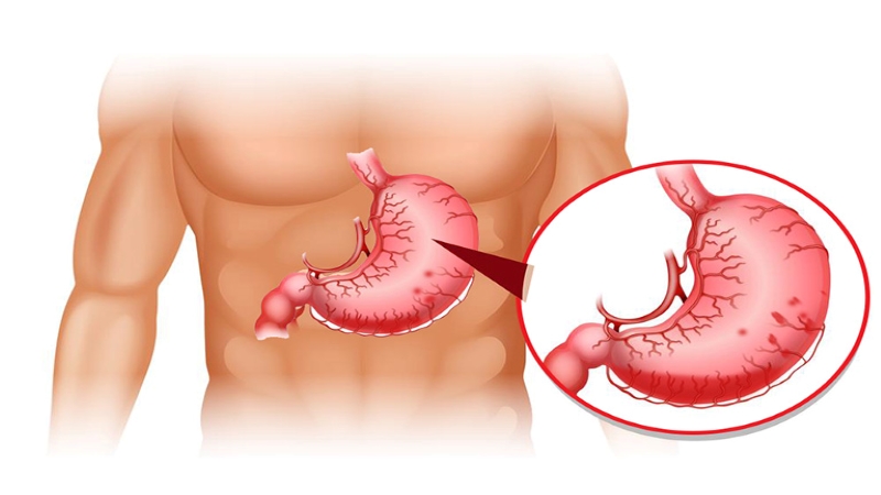 Phosphalugel còn hữu ích trong trường hợp có người bị ngộ độc axit, kiềm, hoặc chất ăn mòn gây xuất huyết dạ dày